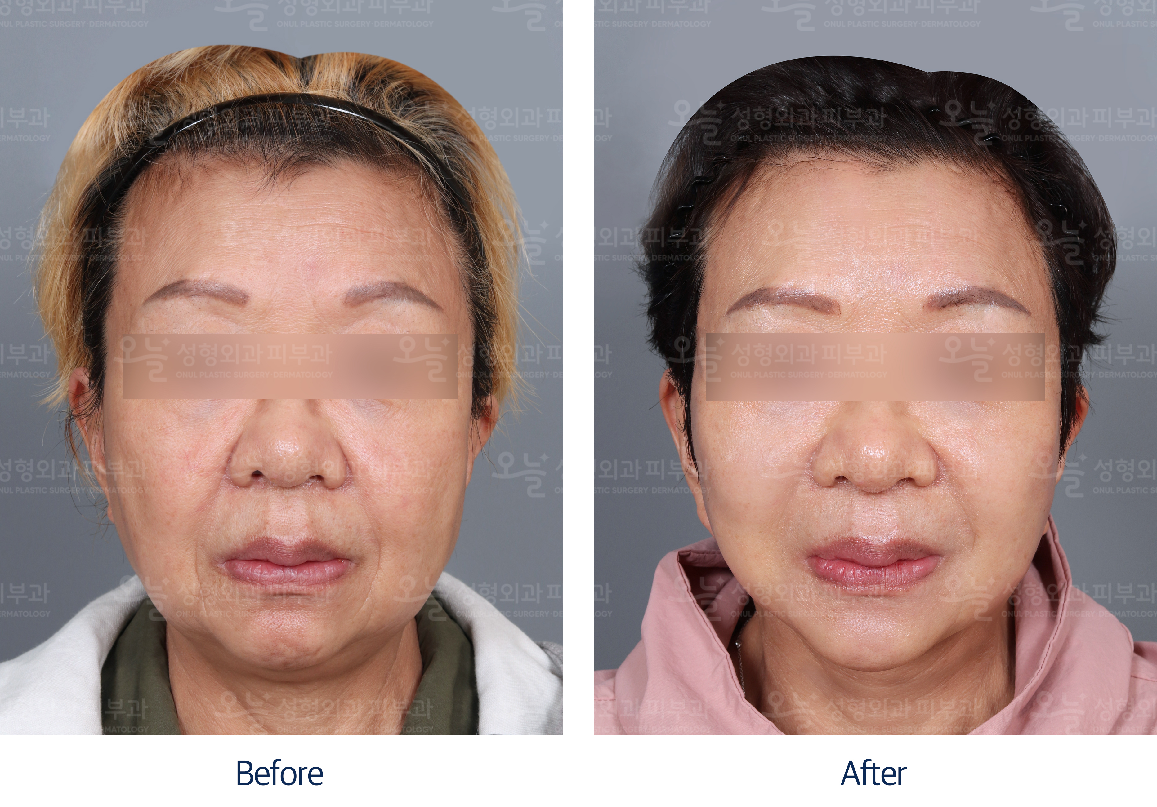오늘성형외과 전후사진