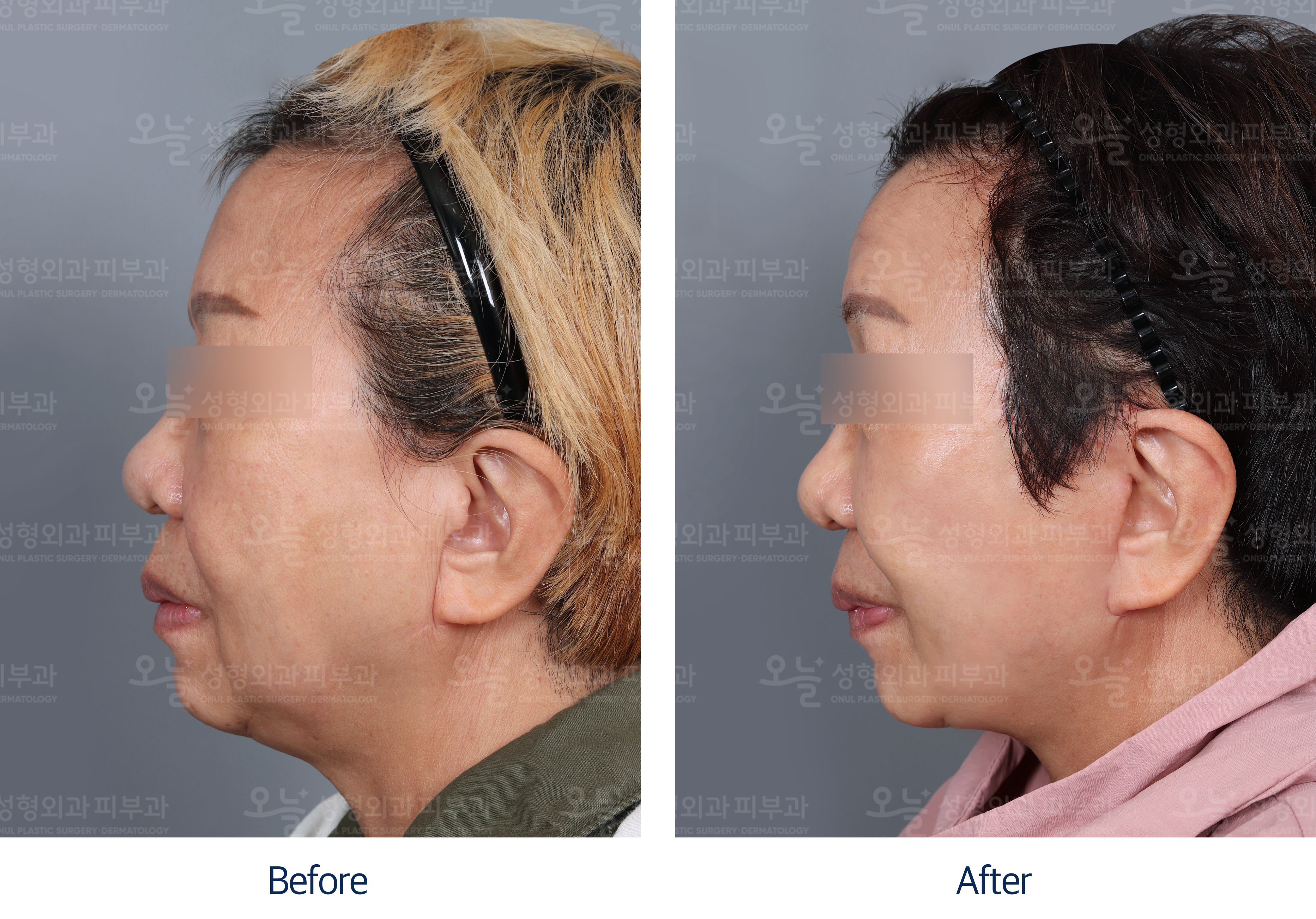 오늘성형외과 전후사진