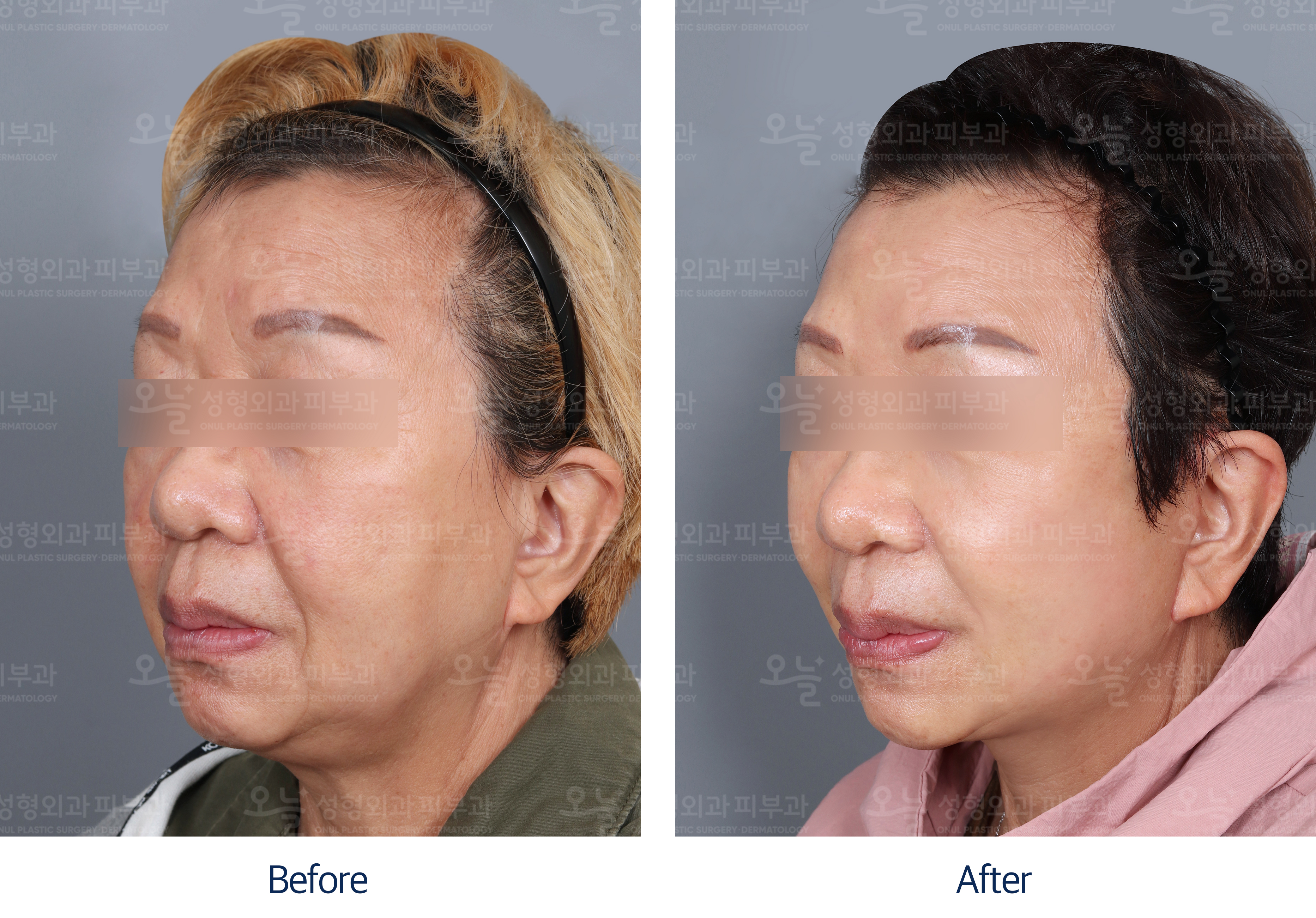 오늘성형외과 전후사진