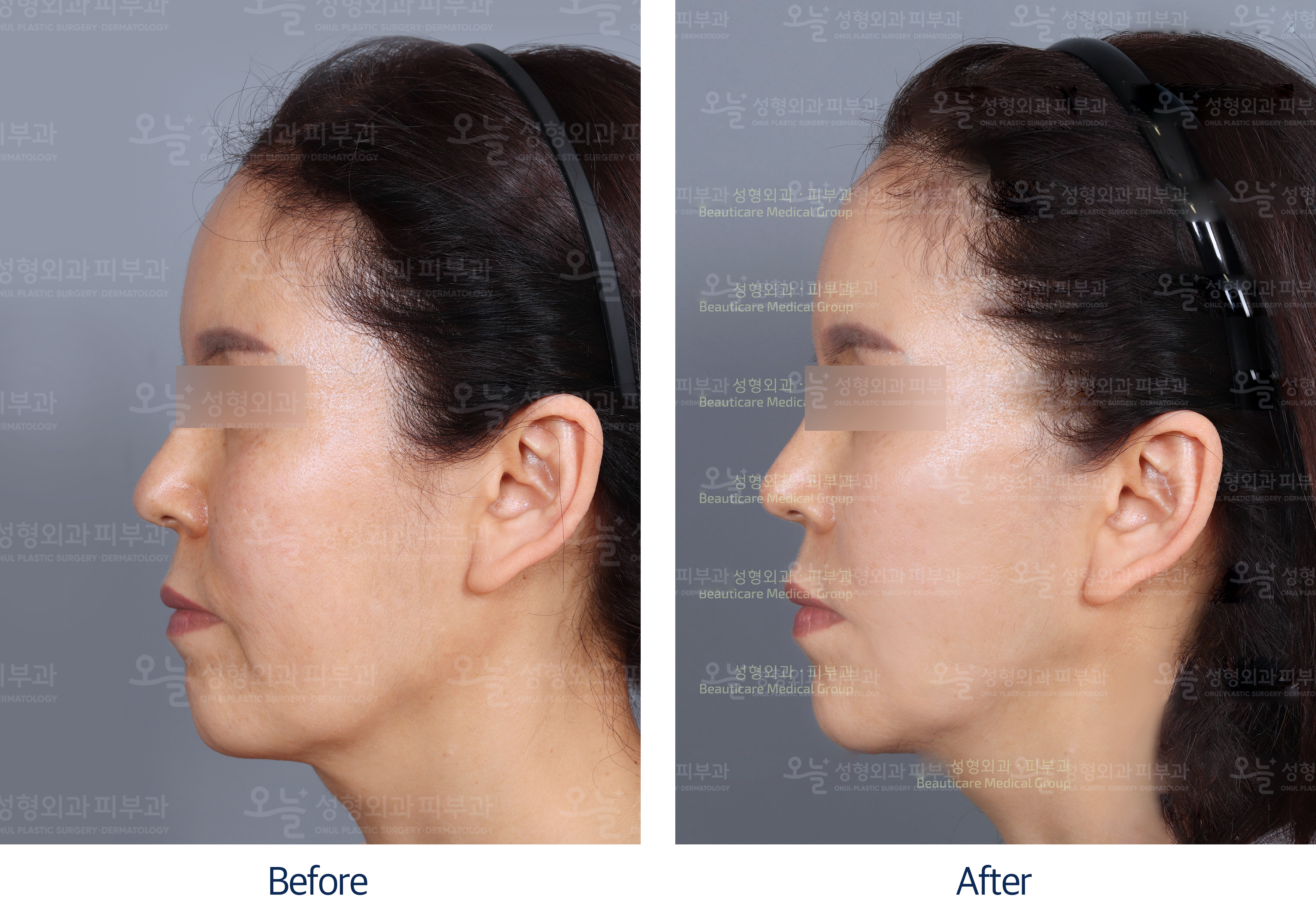 오늘성형외과 전후사진