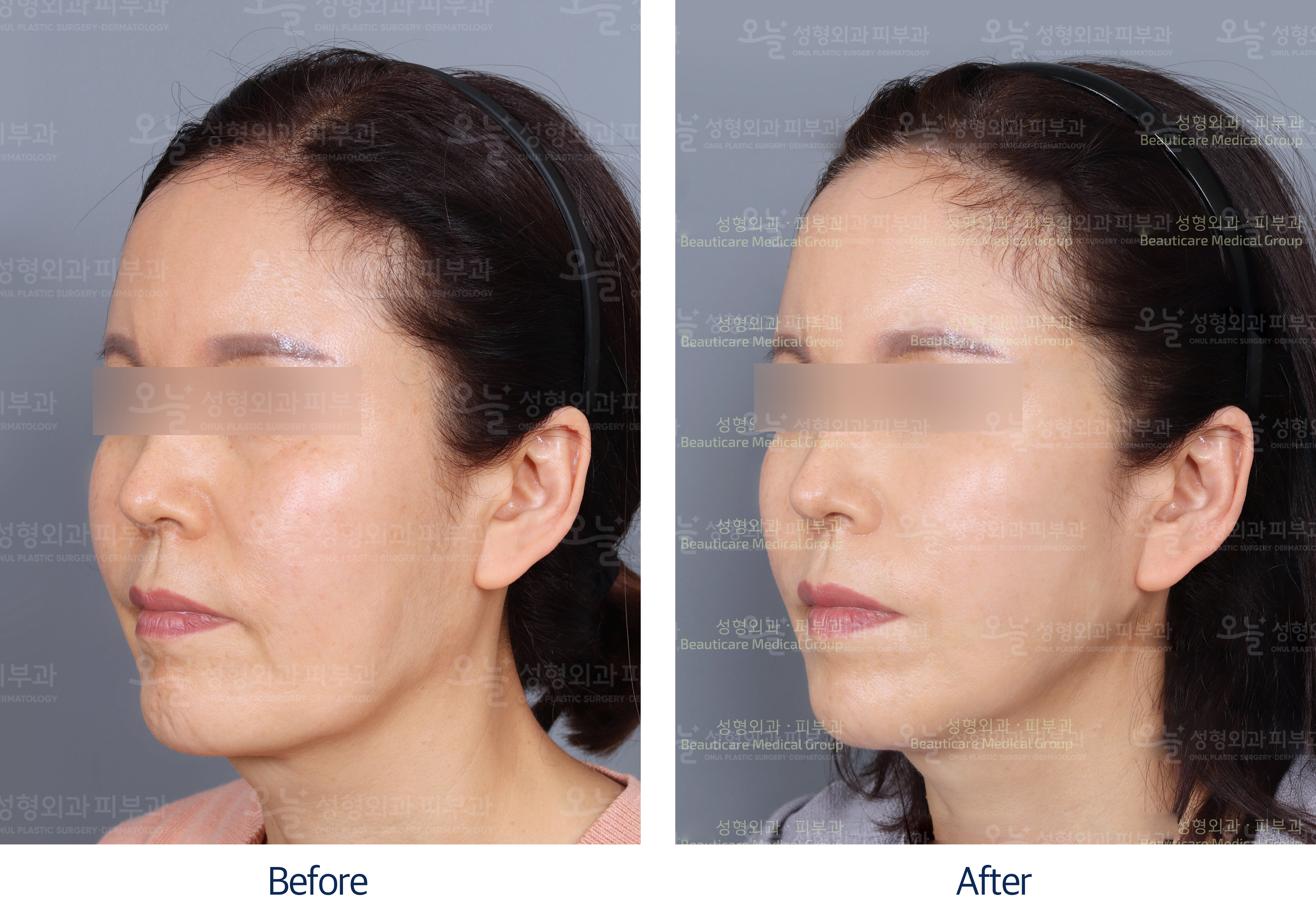 오늘성형외과 전후사진