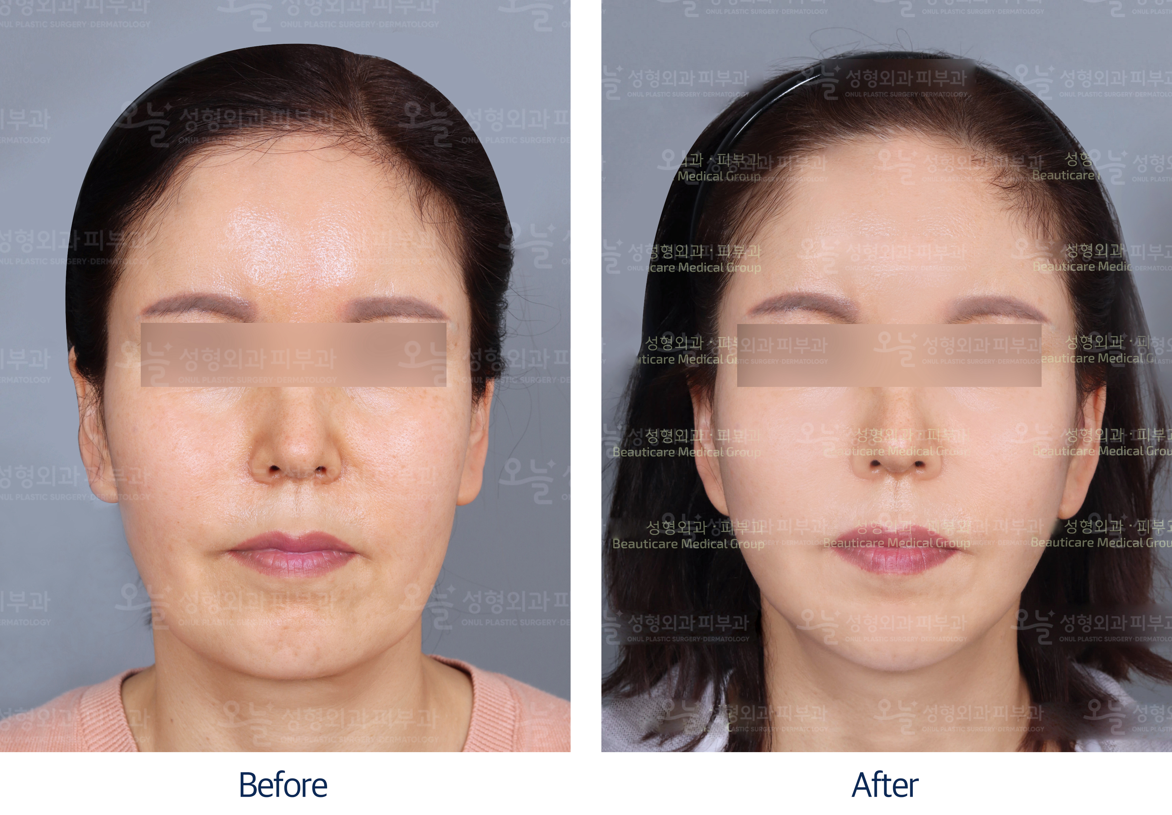 오늘성형외과 전후사진