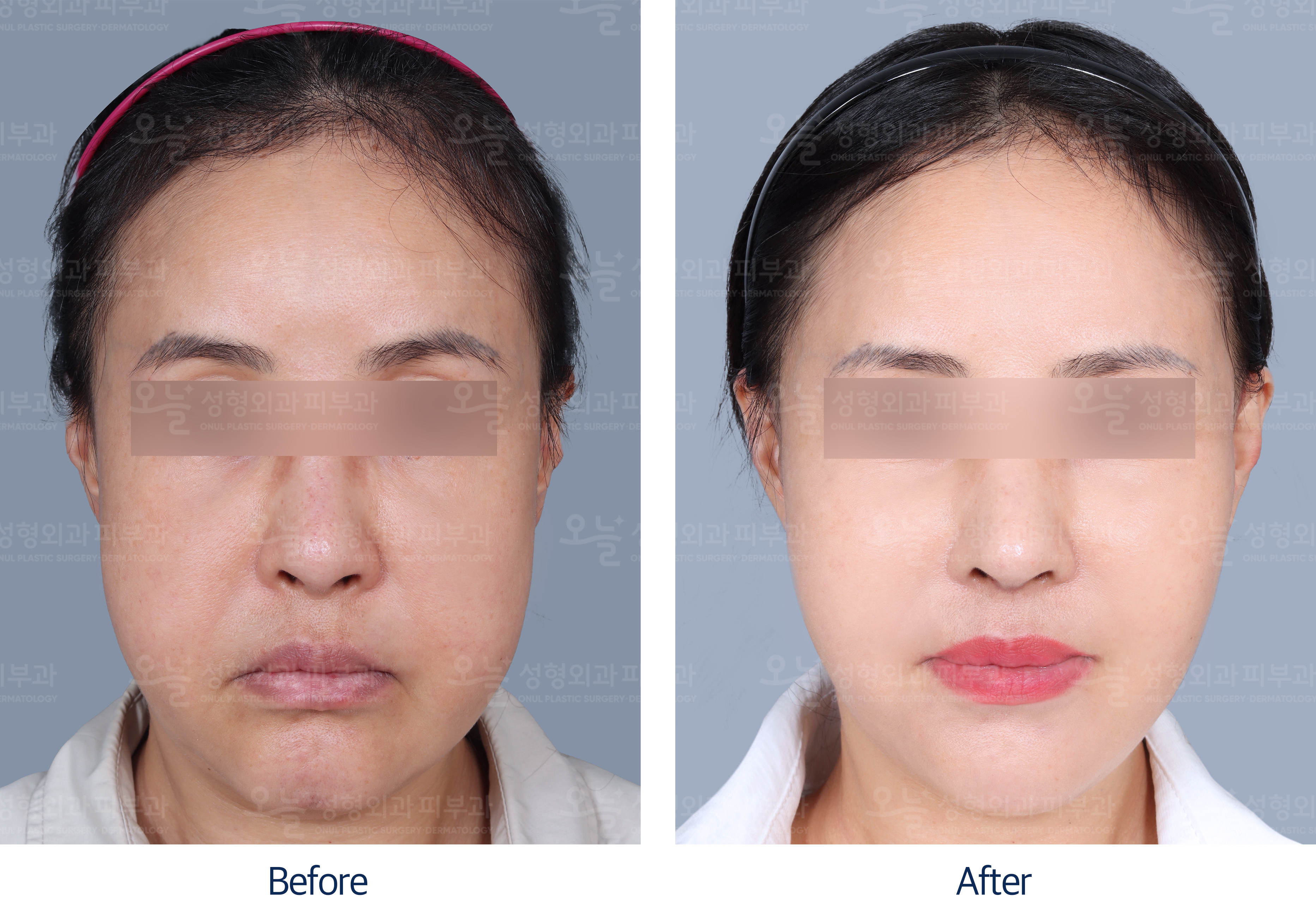오늘성형외과 전후사진