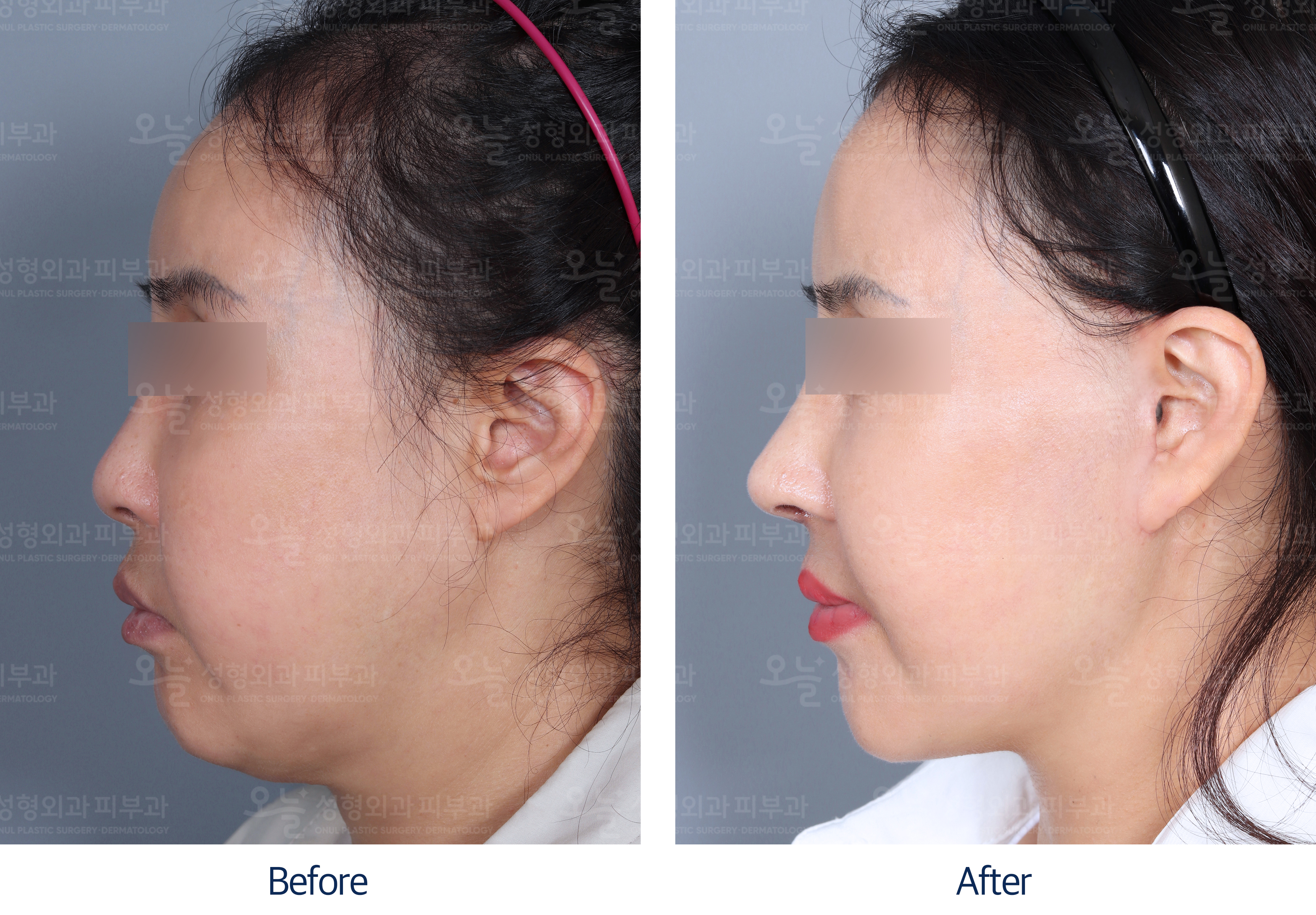 오늘성형외과 전후사진