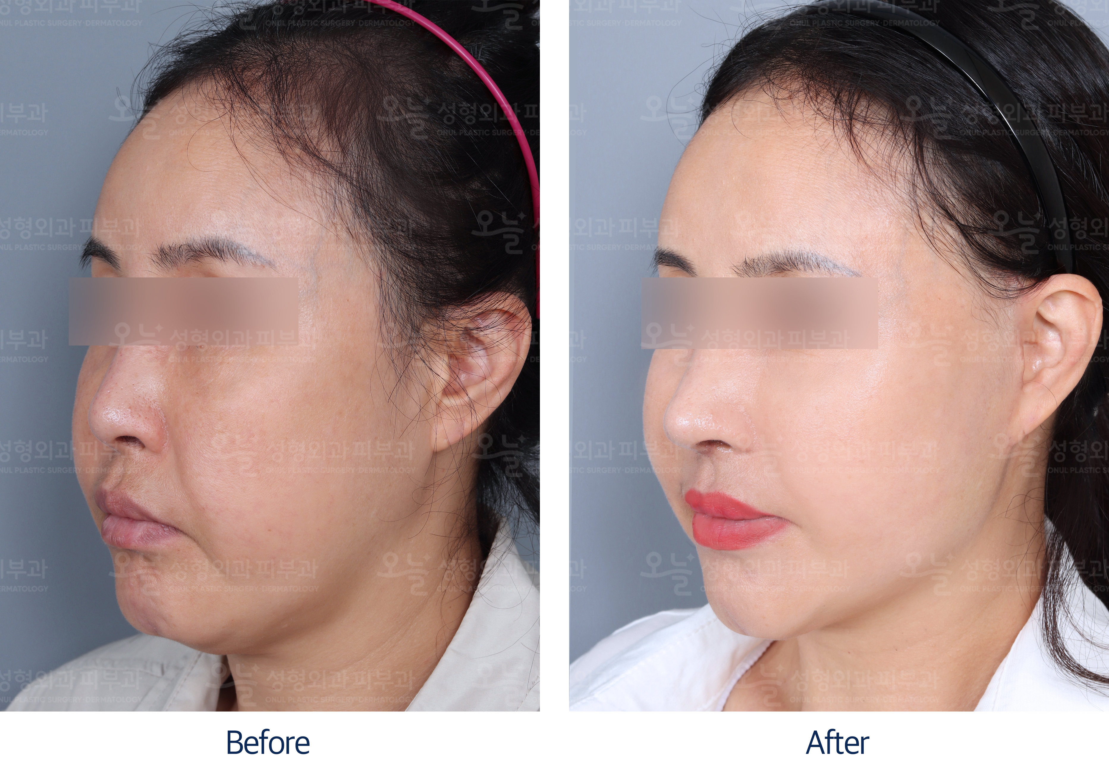 오늘성형외과 전후사진