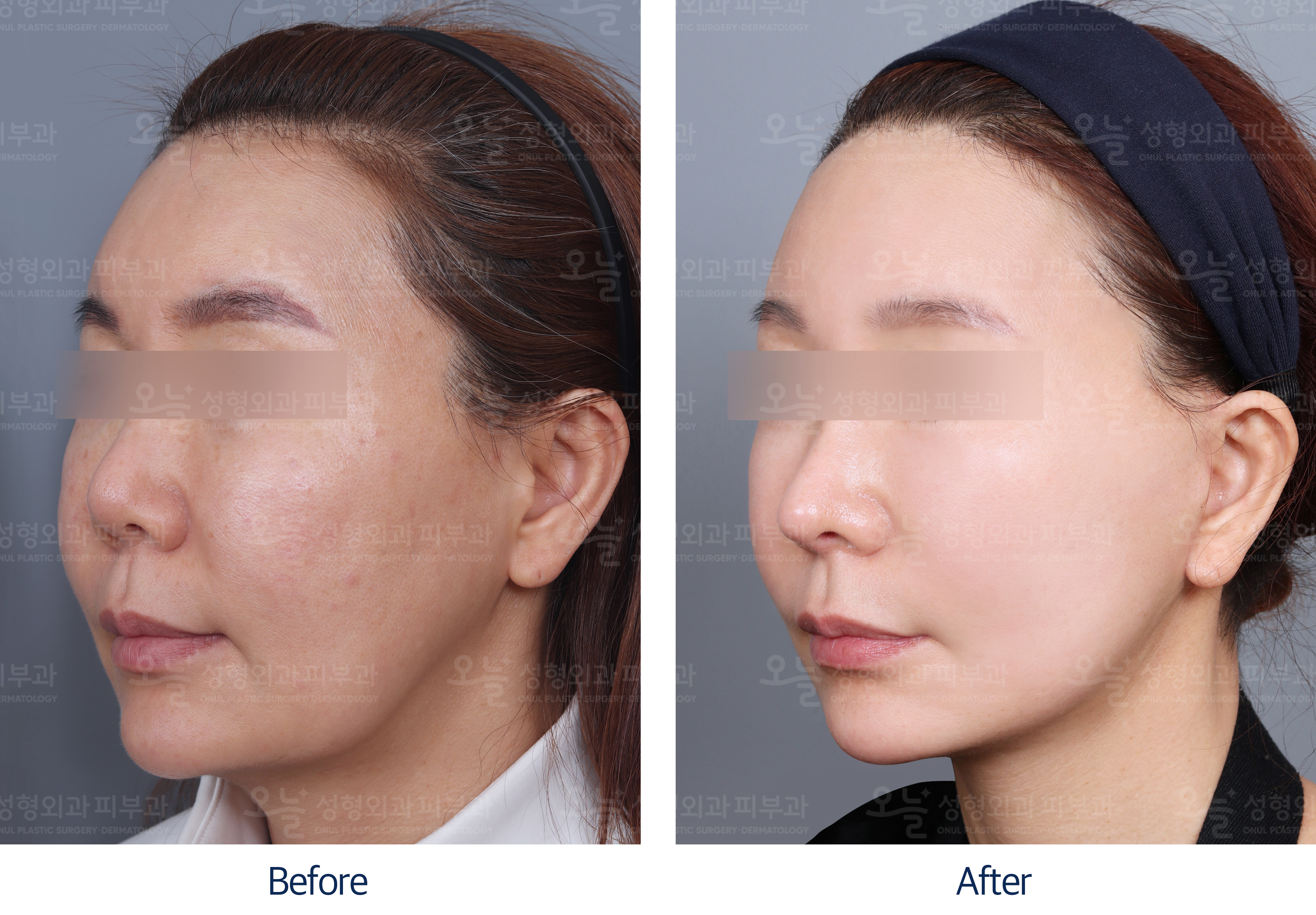 오늘성형외과 전후사진