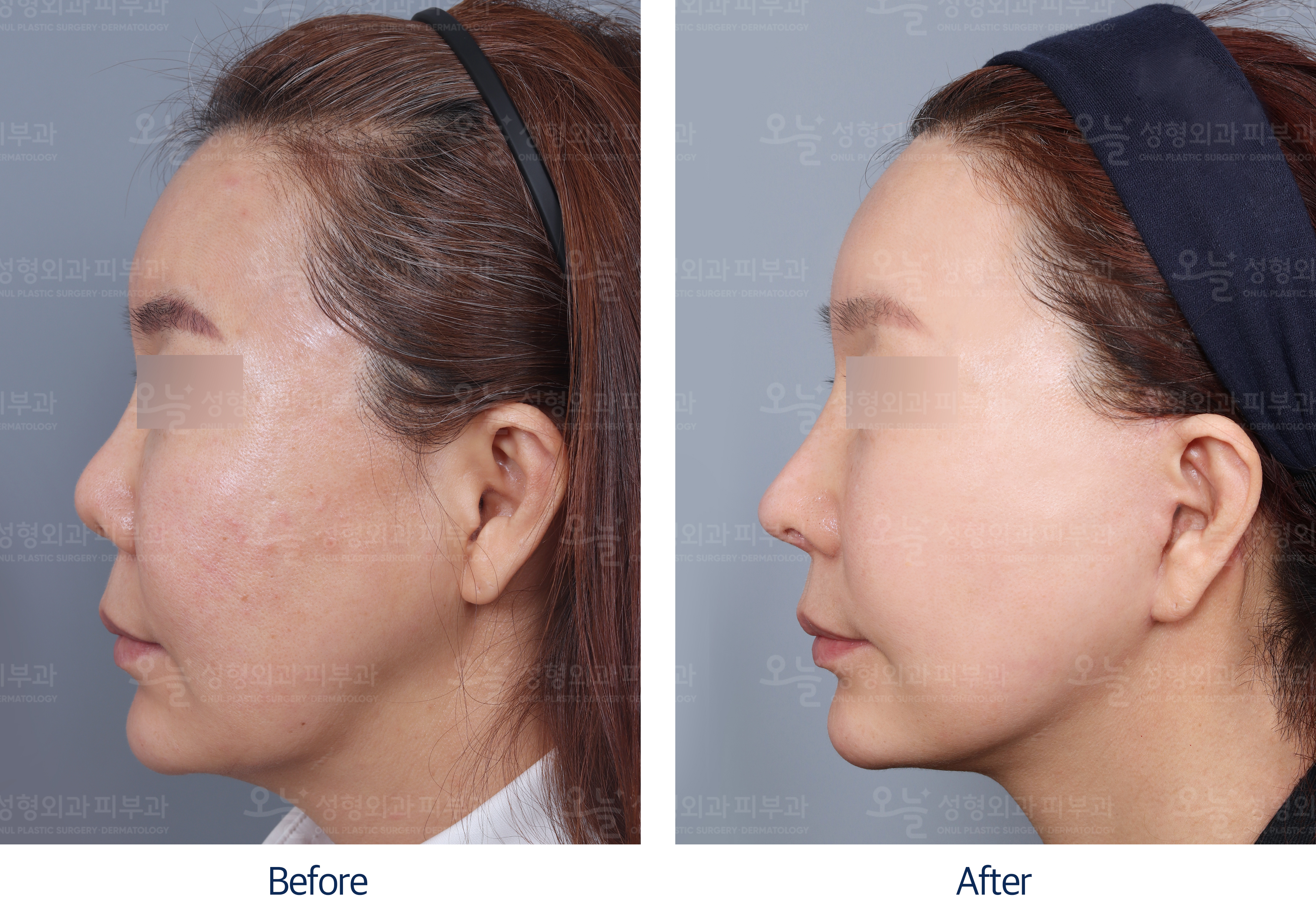 오늘성형외과 전후사진