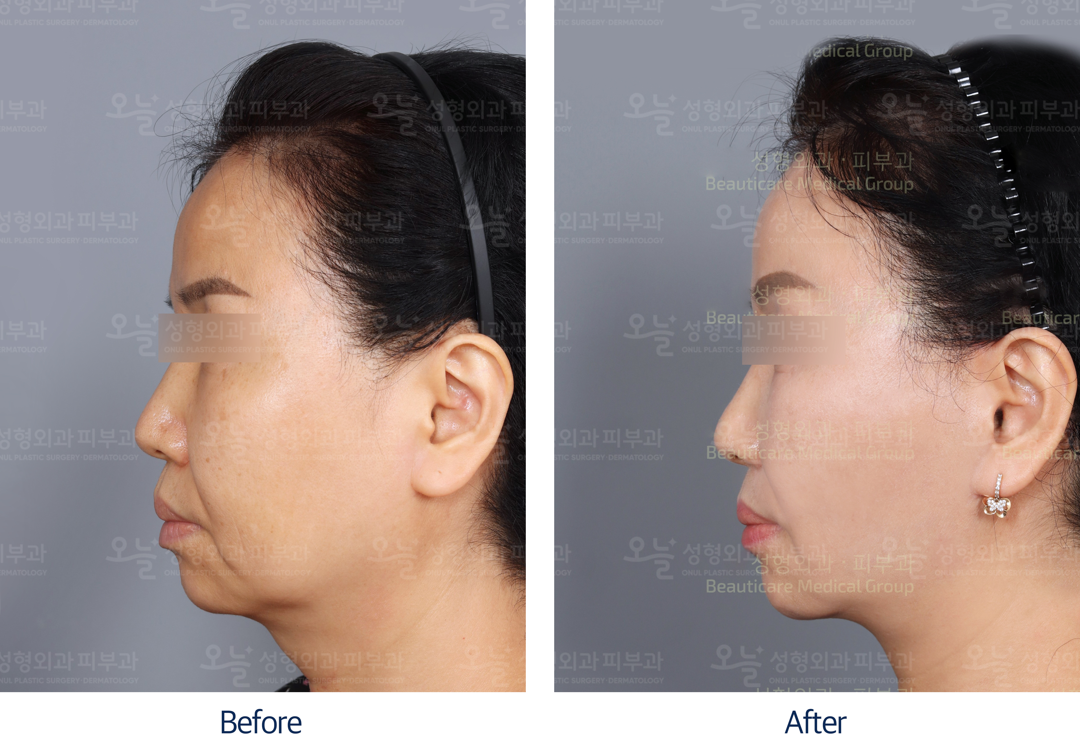 오늘성형외과 전후사진