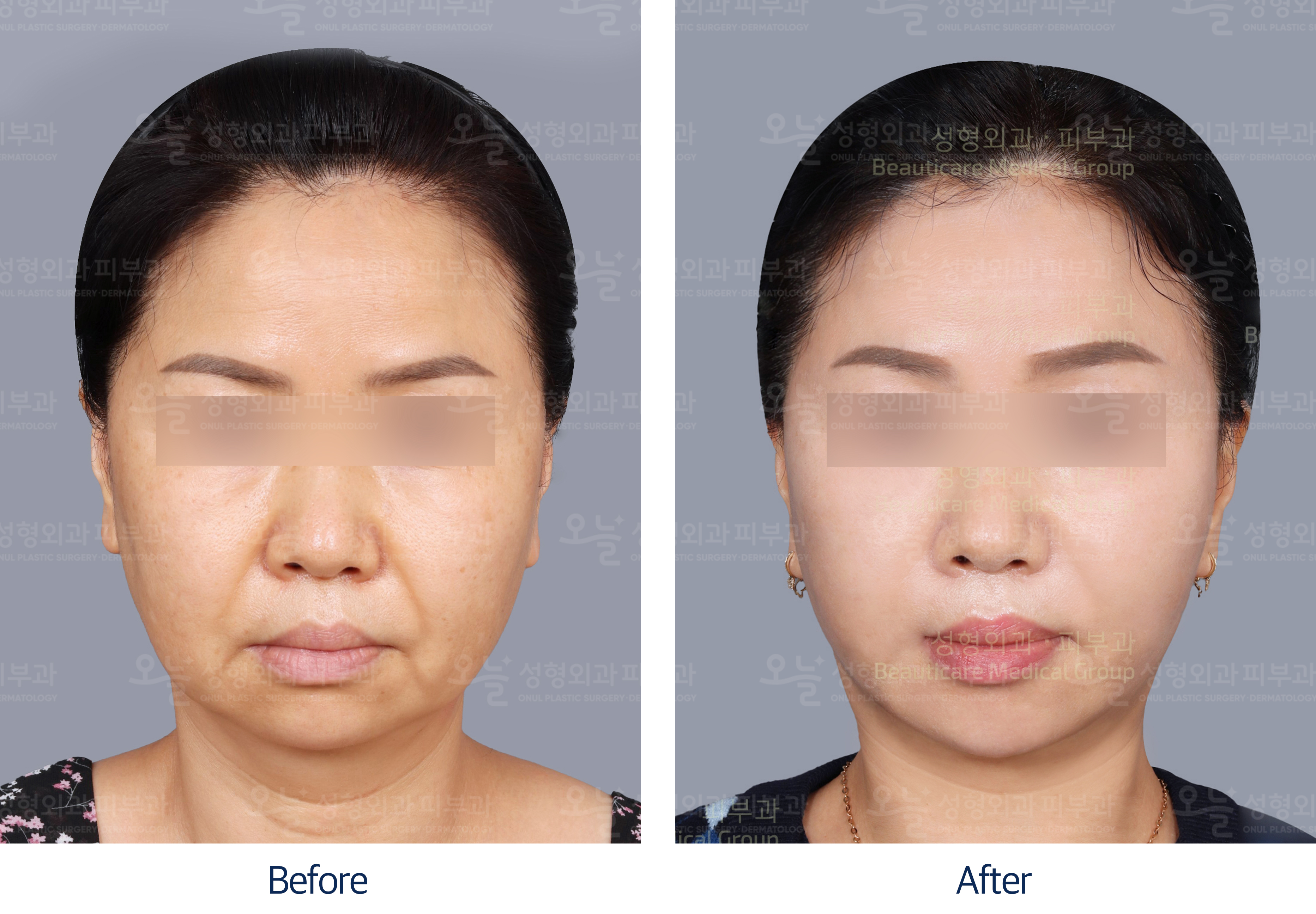오늘성형외과 전후사진