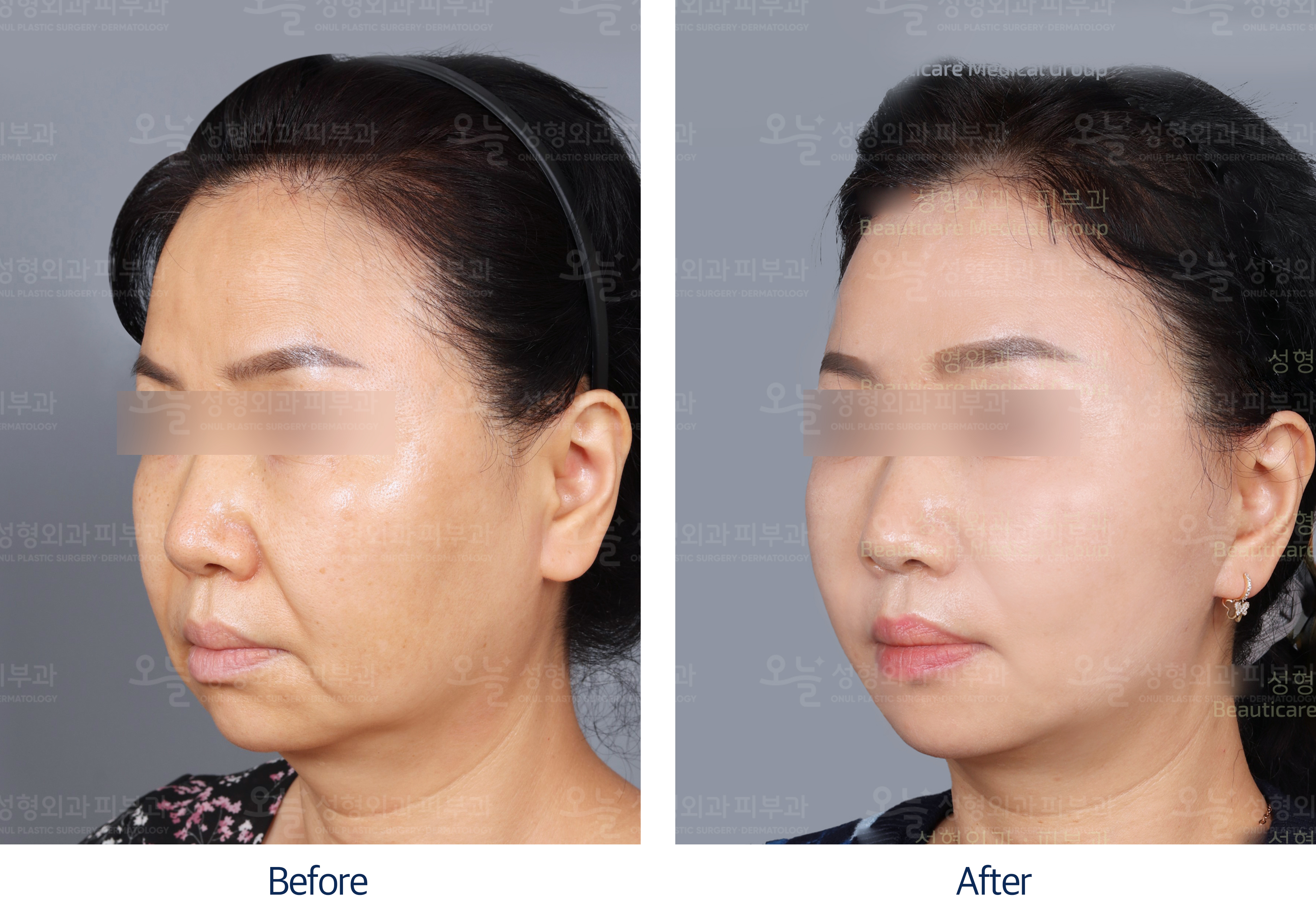 오늘성형외과 전후사진