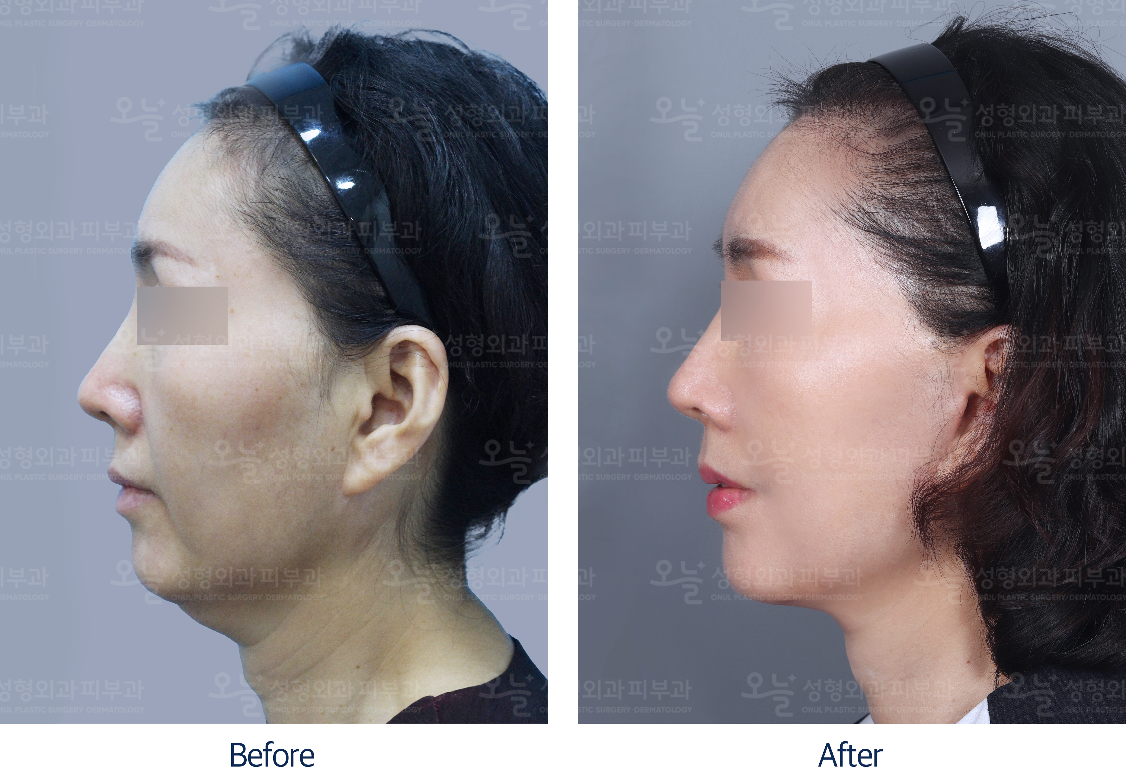 오늘성형외과 전후사진