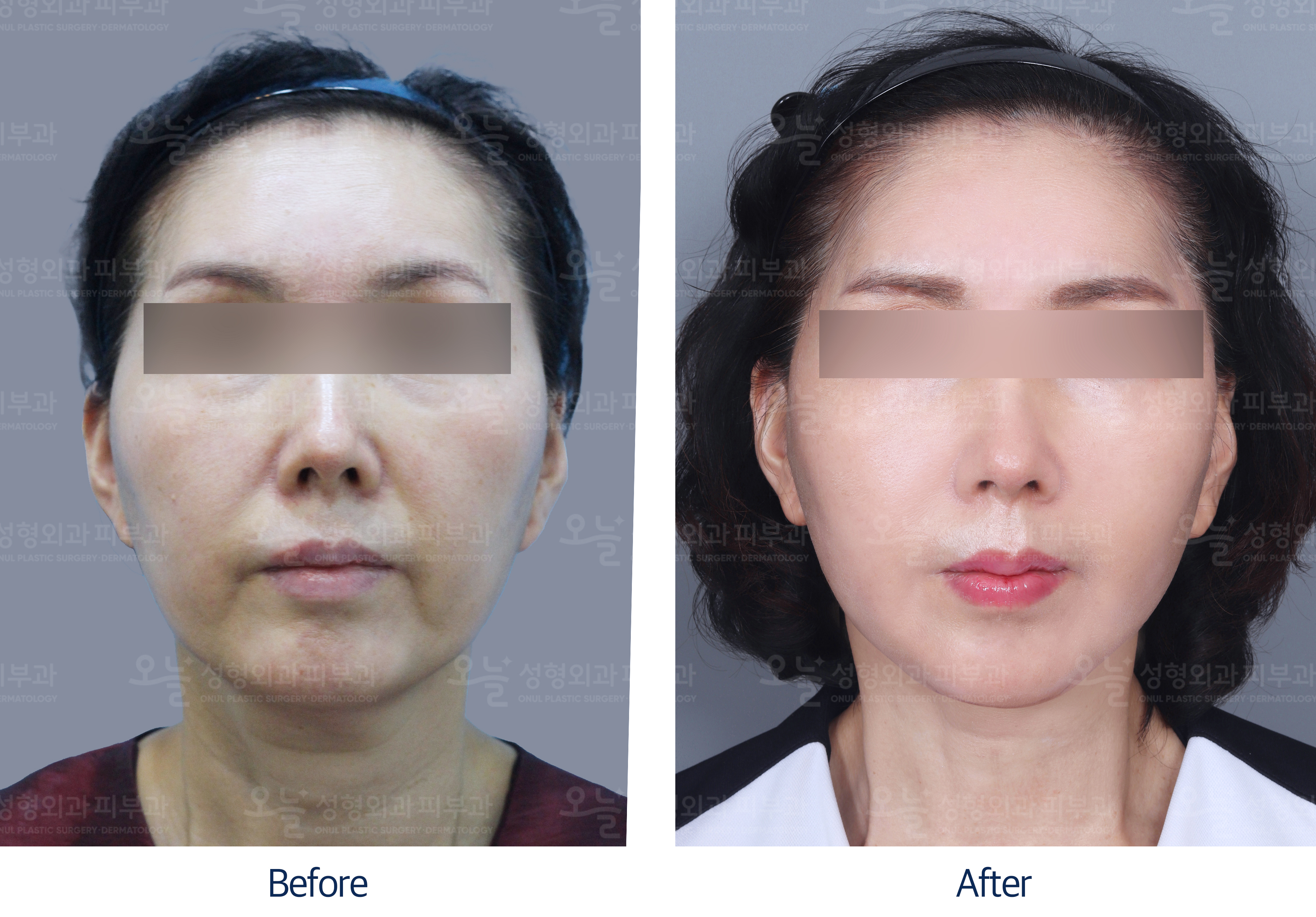 오늘성형외과 전후사진