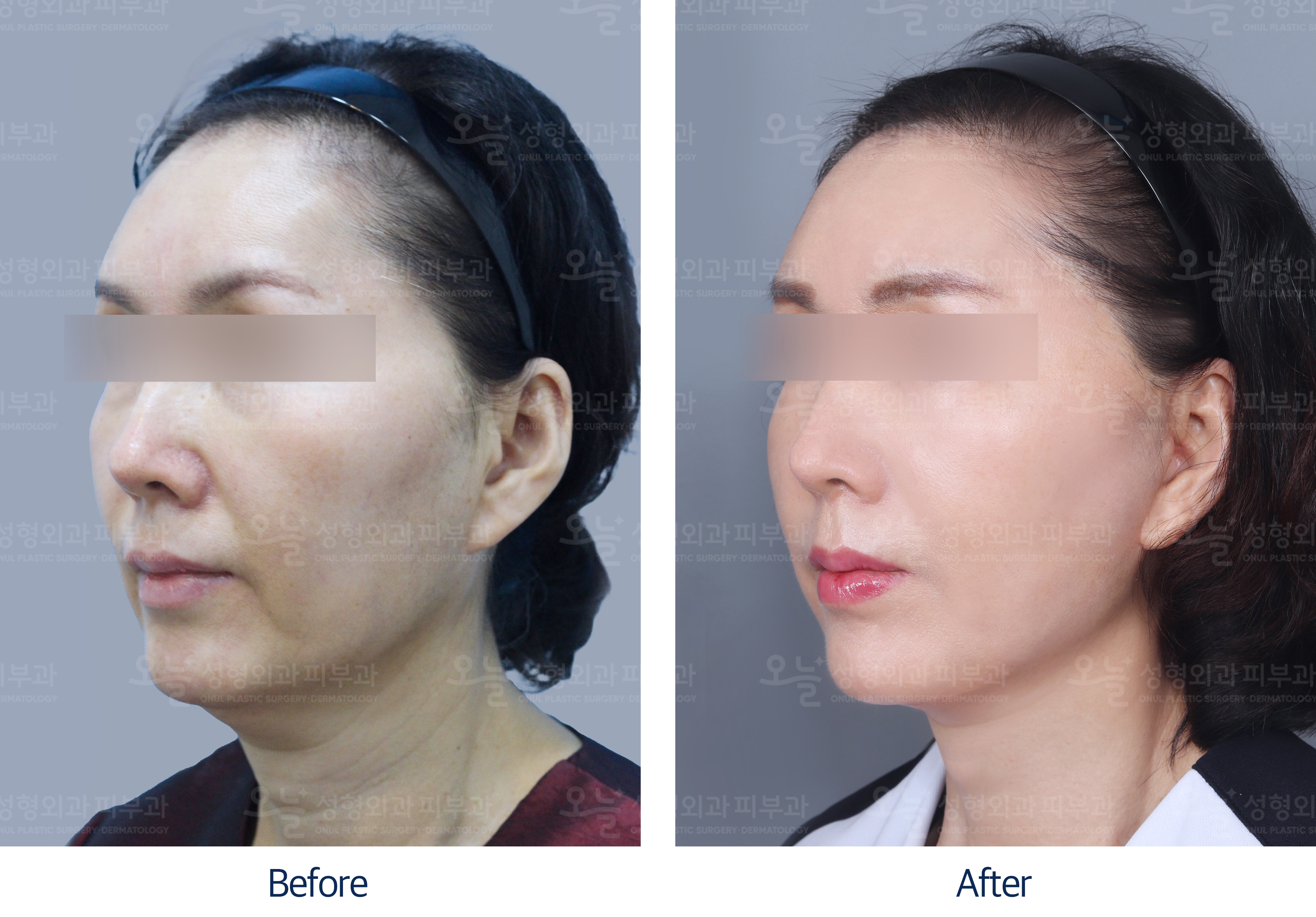 오늘성형외과 전후사진