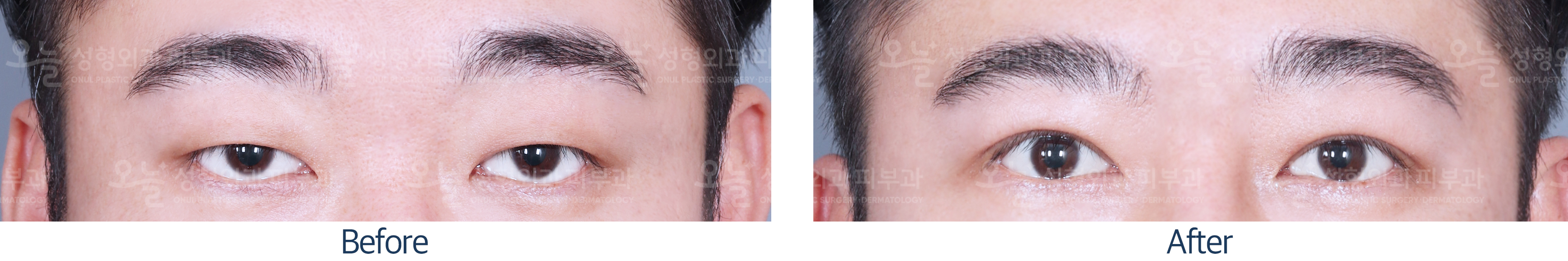 오늘성형외과 전후사진