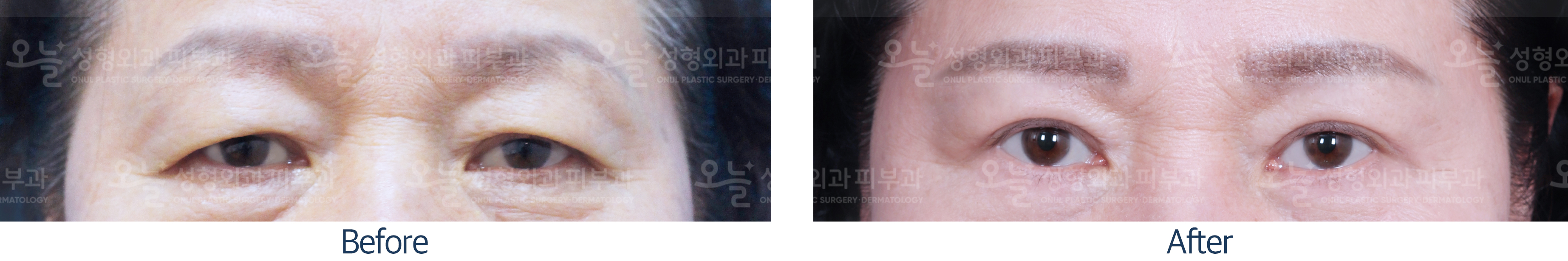 오늘성형외과 전후사진