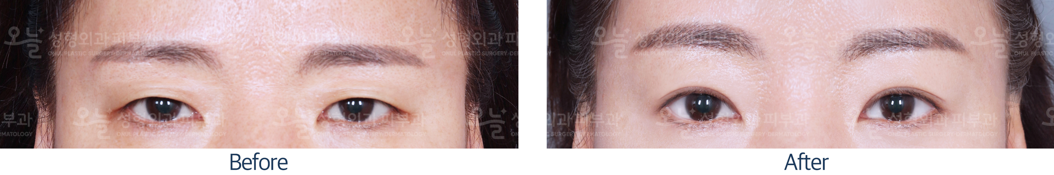 오늘성형외과 전후사진