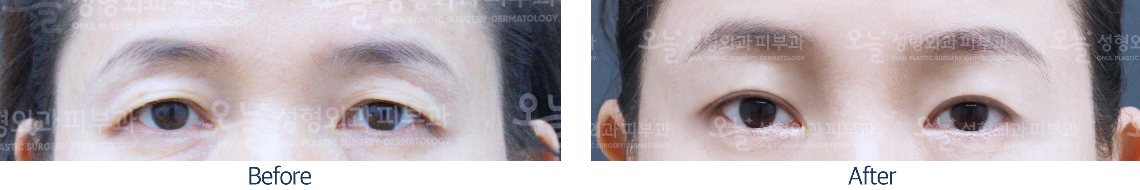 오늘성형외과 전후사진