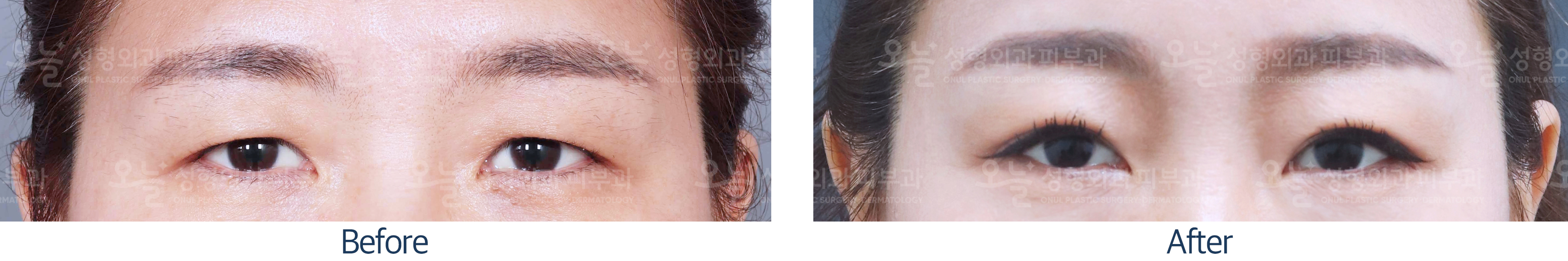 오늘성형외과 전후사진