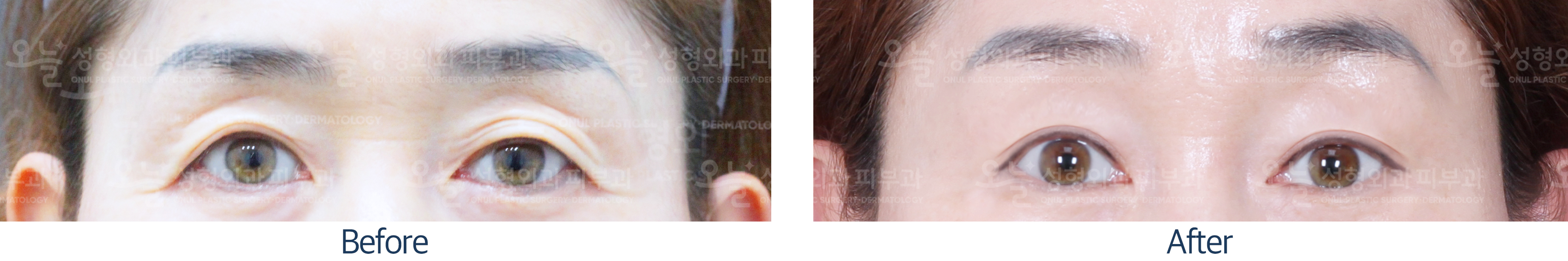 오늘성형외과 전후사진