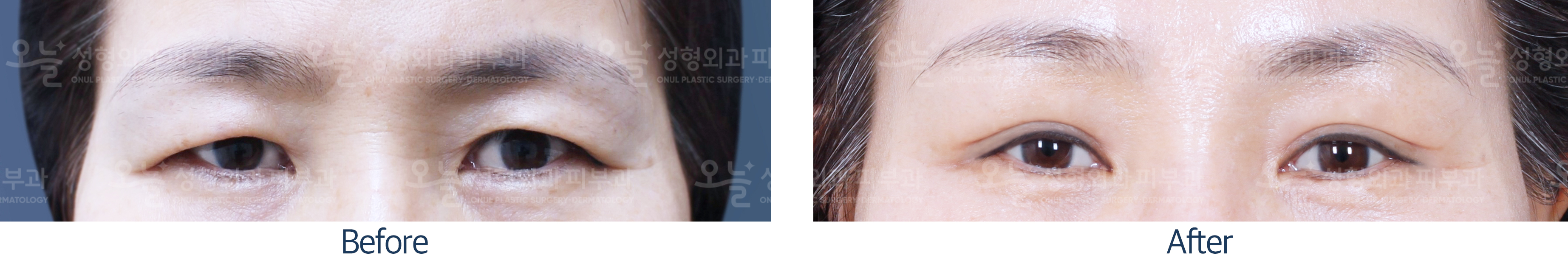 오늘성형외과 전후사진