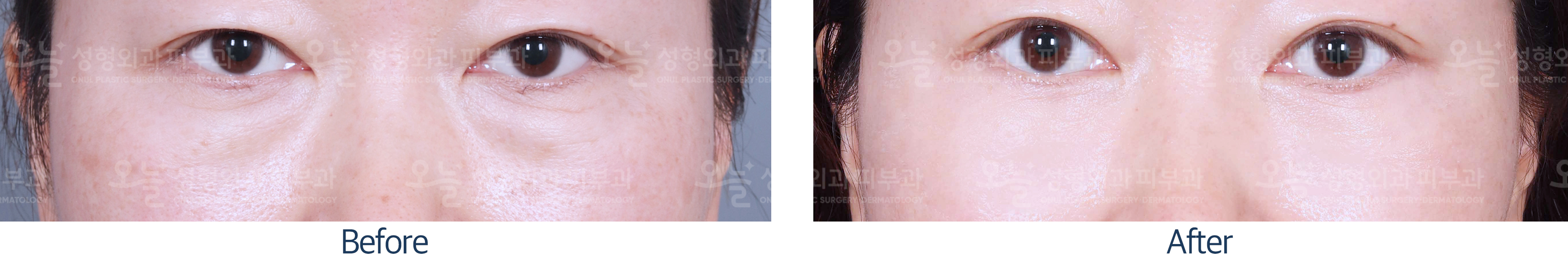 오늘성형외과 전후사진