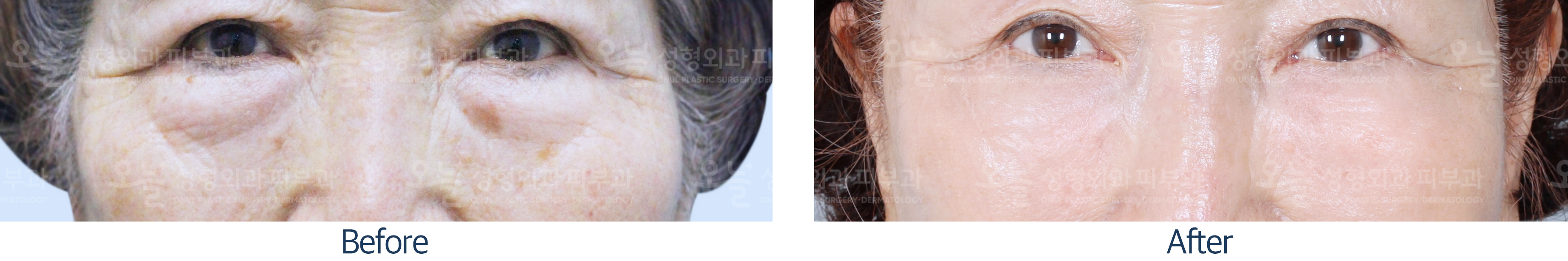 오늘성형외과 전후사진