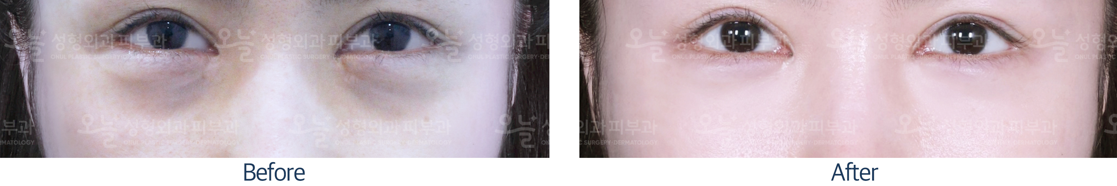 오늘성형외과 전후사진