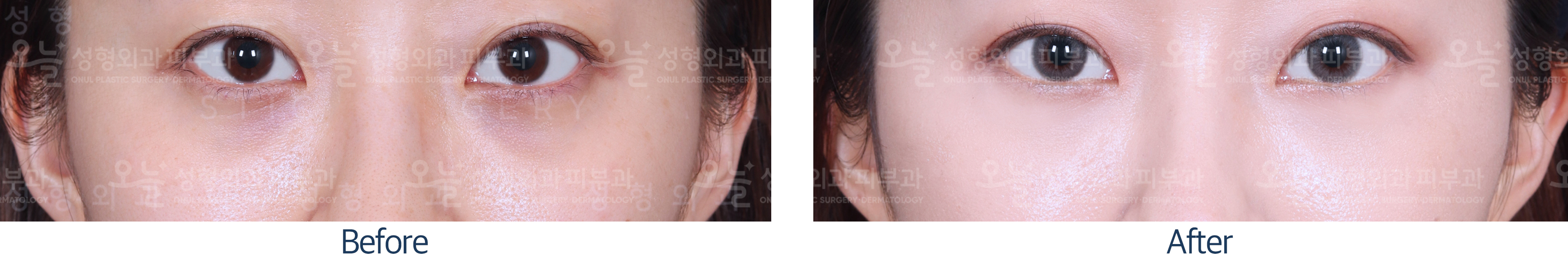 오늘성형외과 전후사진