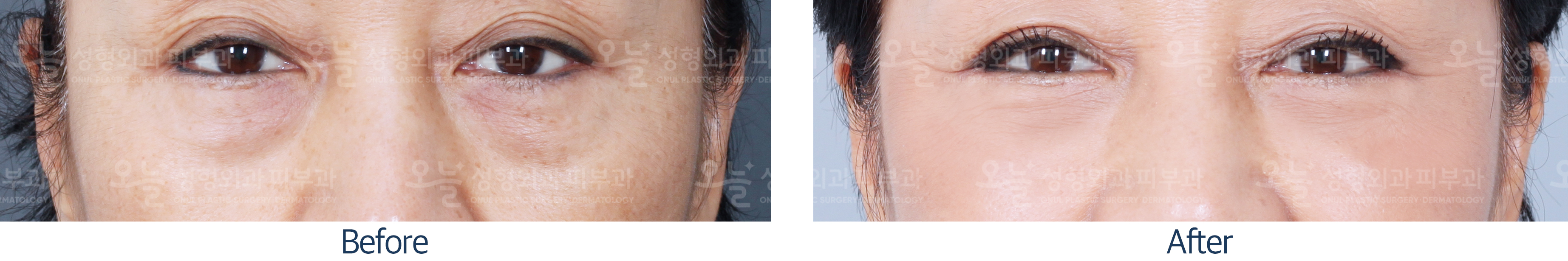 오늘성형외과 전후사진