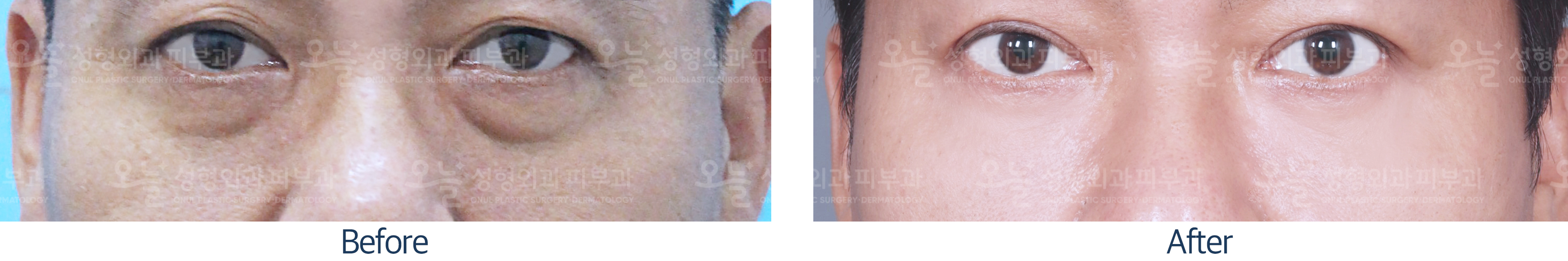 오늘성형외과 전후사진
