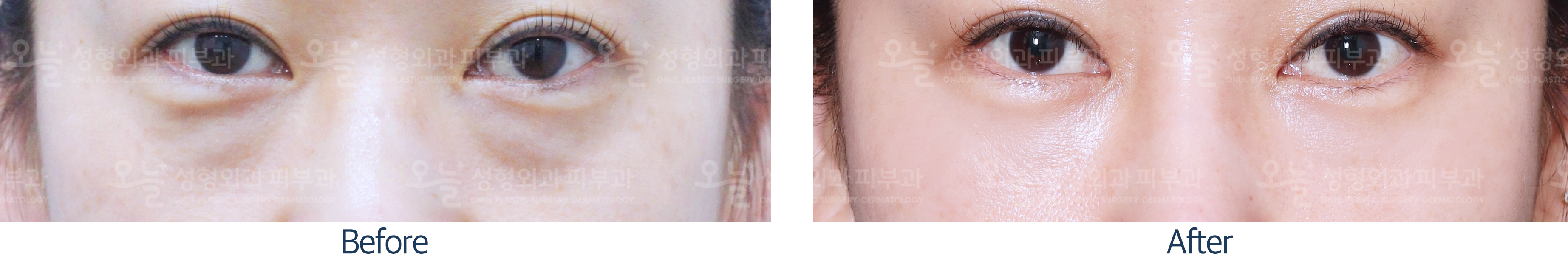 오늘성형외과 전후사진