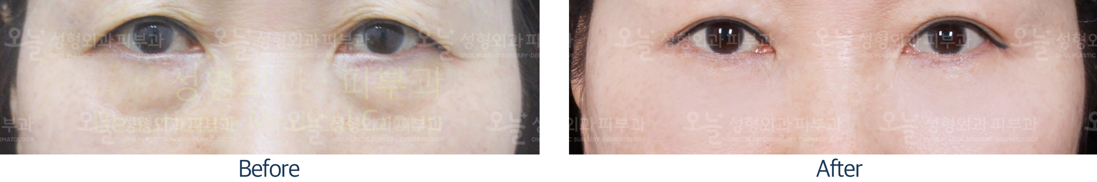 오늘성형외과 전후사진