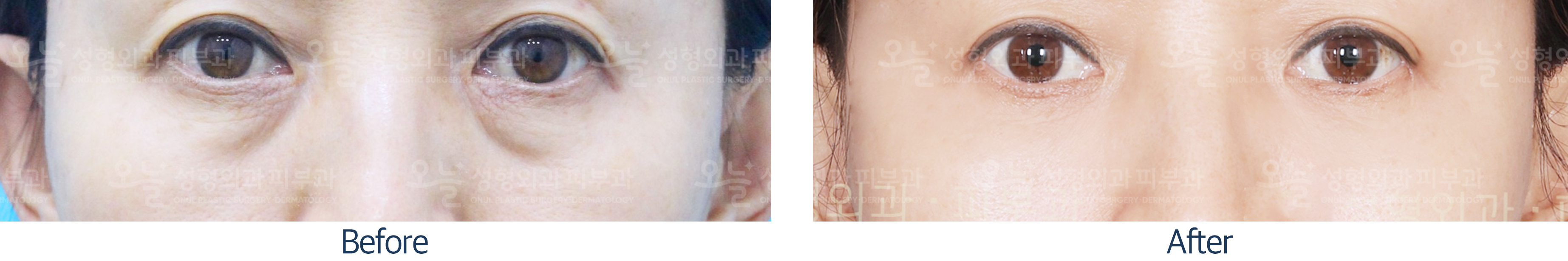 오늘성형외과 전후사진