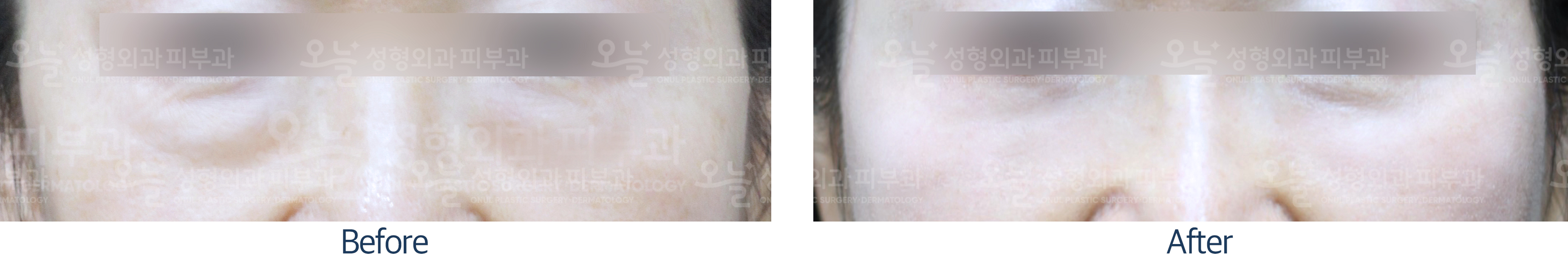 오늘성형외과 전후사진