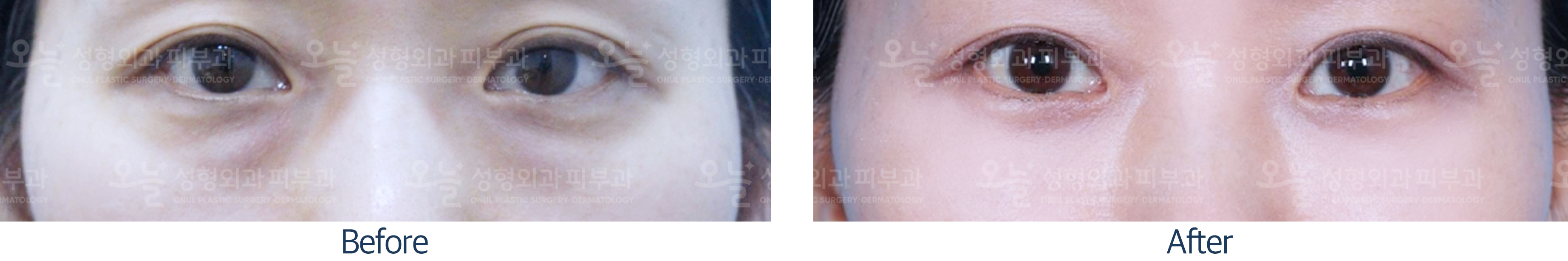 오늘성형외과 전후사진
