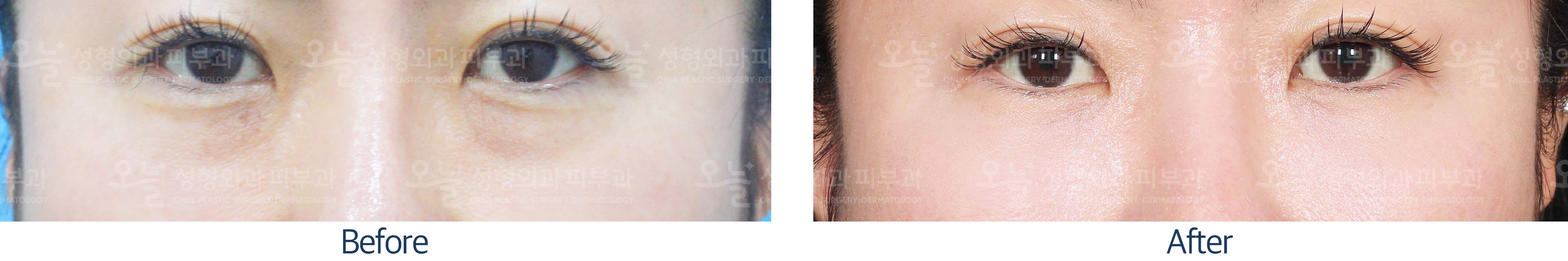 오늘성형외과 전후사진