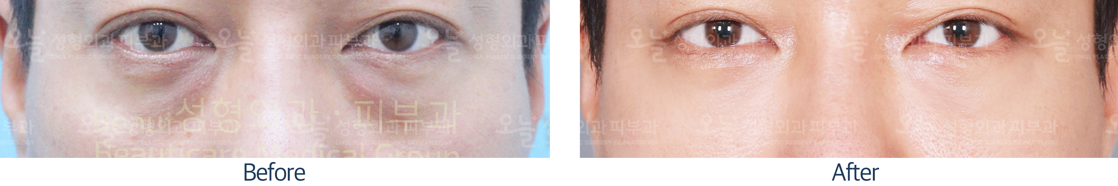 오늘성형외과 전후사진