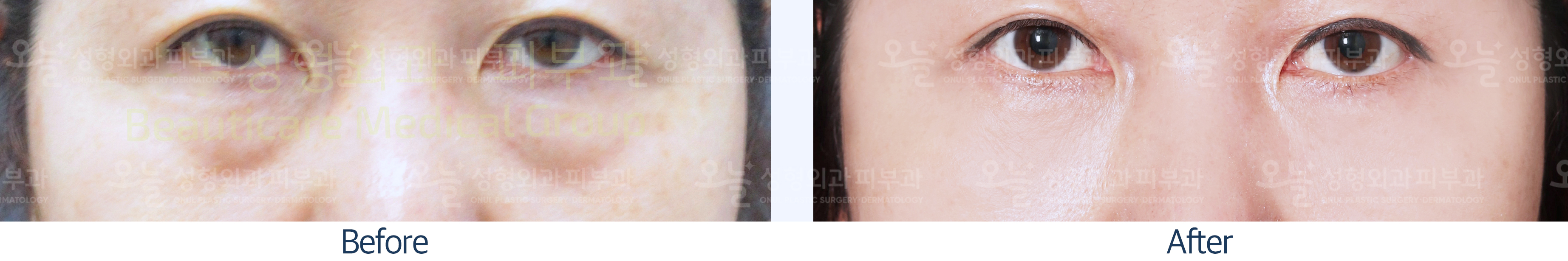 오늘성형외과 전후사진
