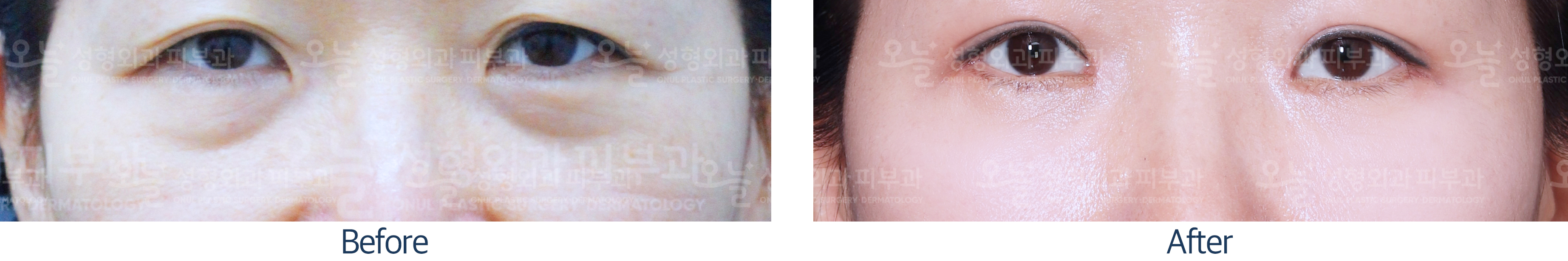 오늘성형외과 전후사진