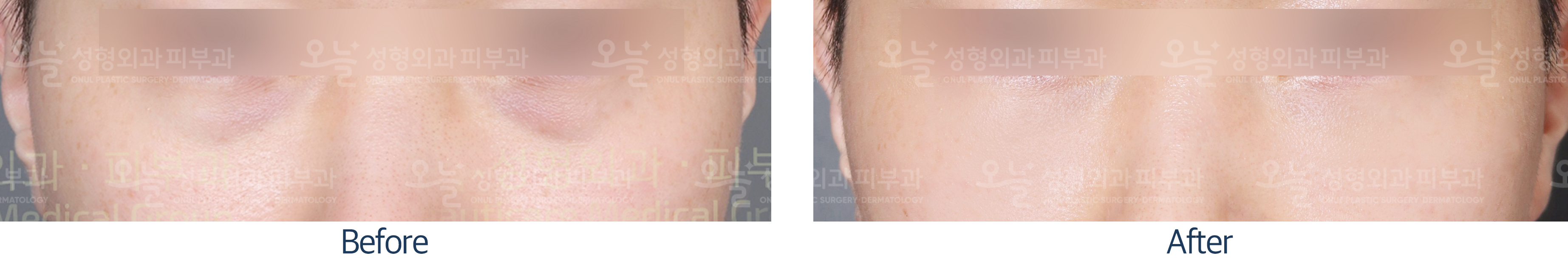 오늘성형외과 전후사진