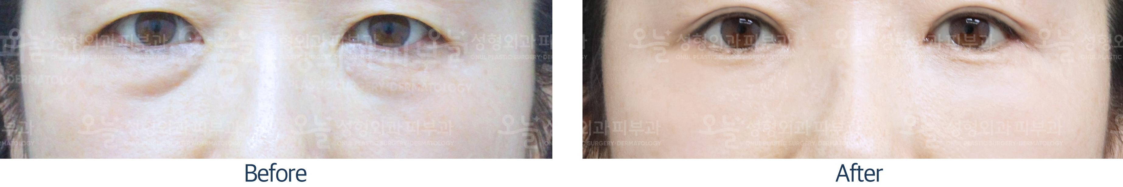 오늘성형외과 전후사진