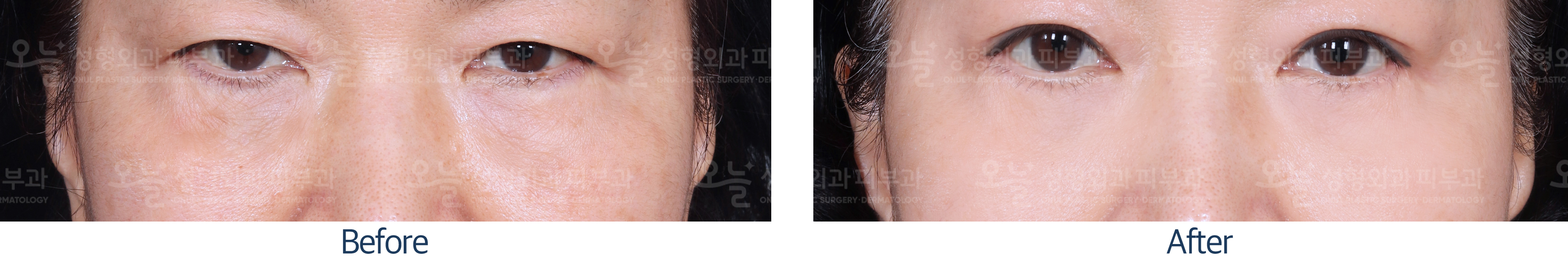 오늘성형외과 전후사진