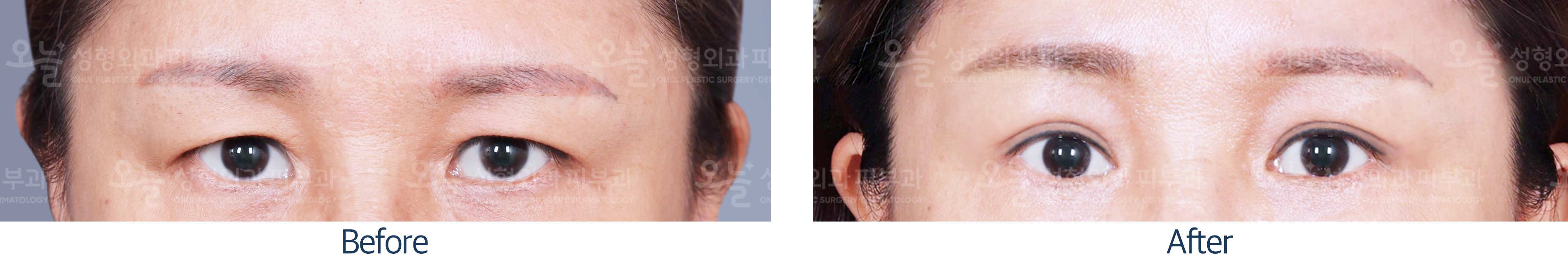 오늘성형외과 전후사진