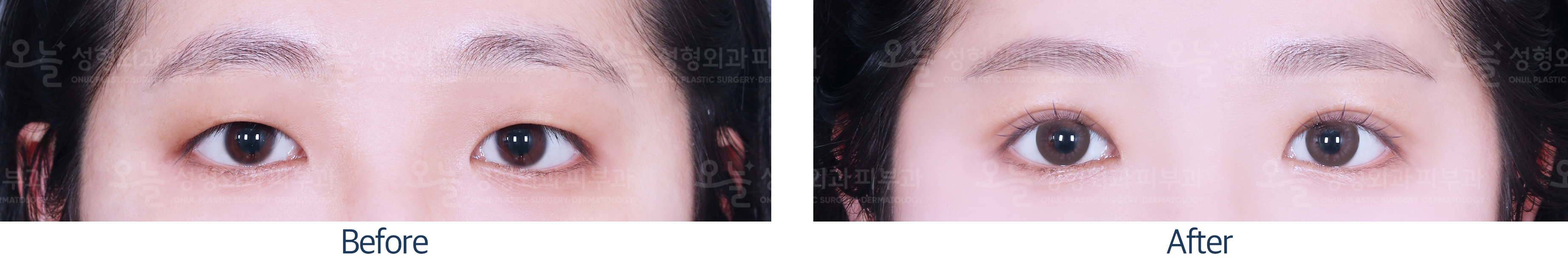 오늘성형외과 전후사진