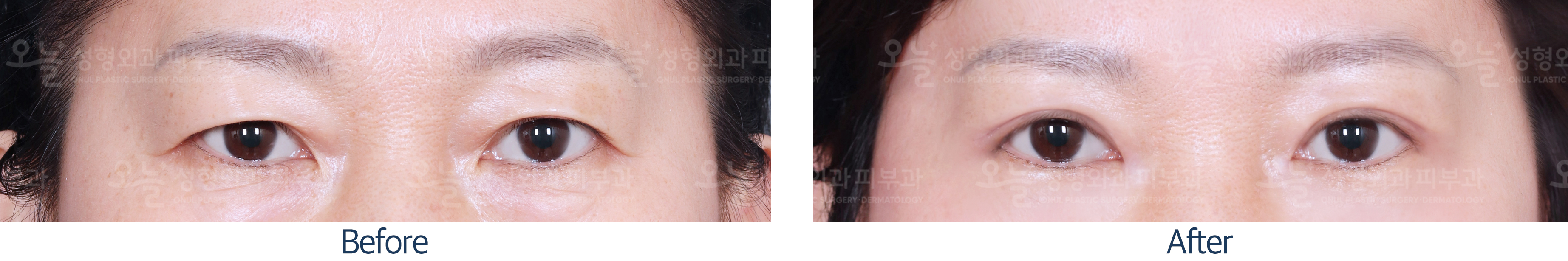 오늘성형외과 전후사진