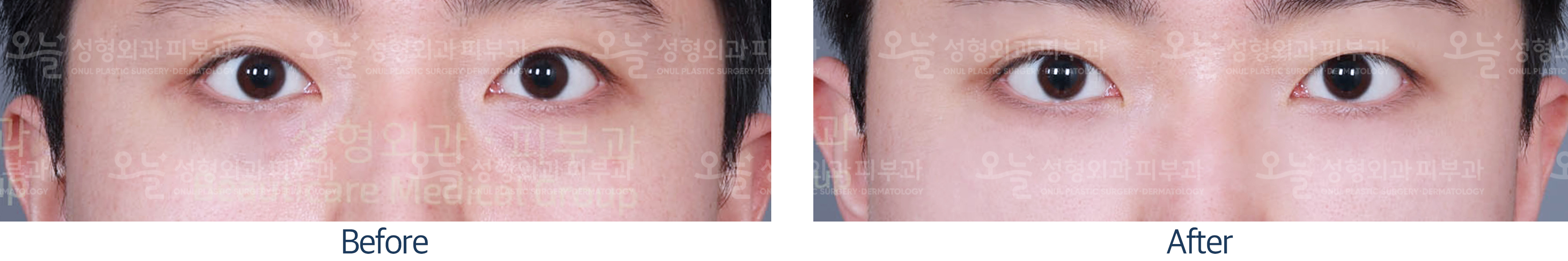 오늘성형외과 전후사진