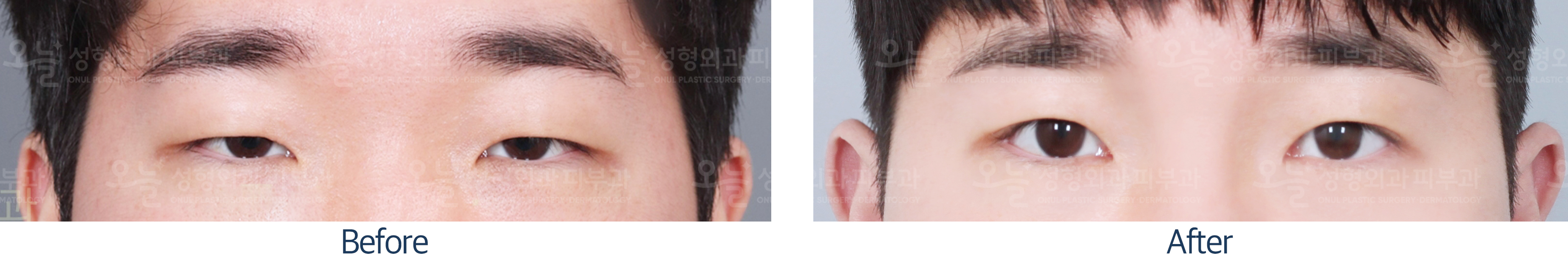 오늘성형외과 전후사진