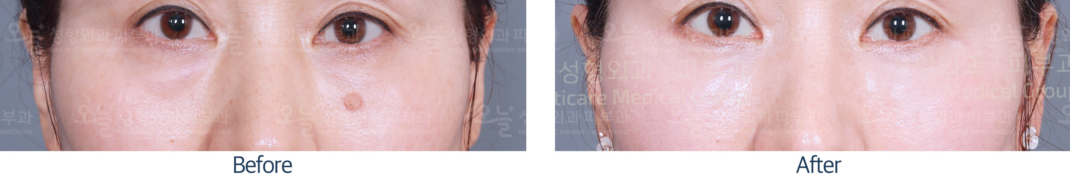 오늘성형외과 전후사진