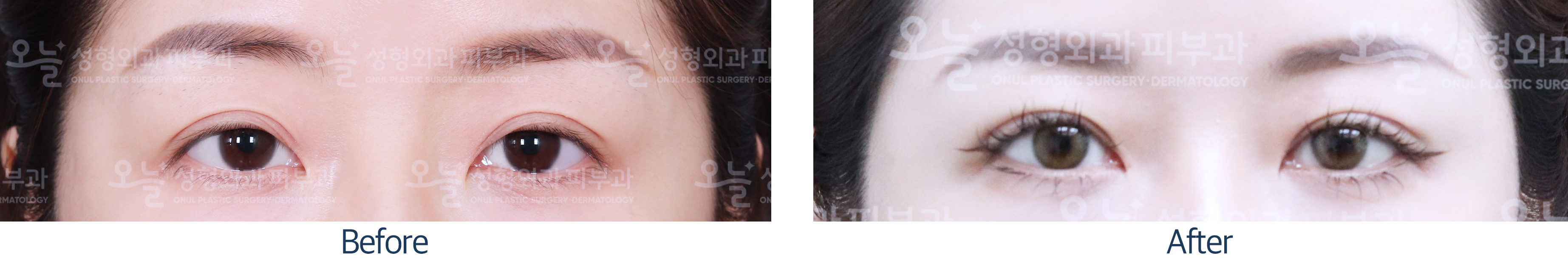 오늘성형외과 전후사진