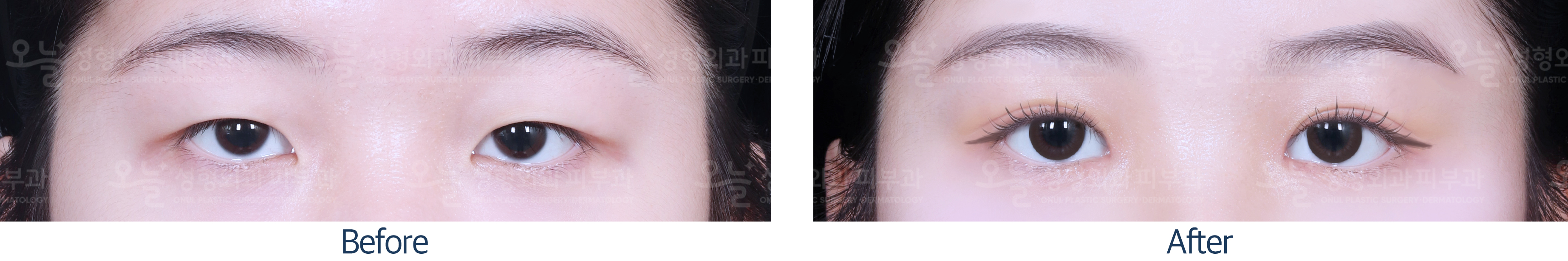 오늘성형외과 전후사진